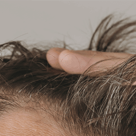 Qu'est-ce que la dermatite séborrhéique ?