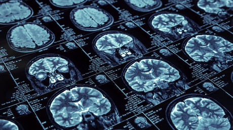 Esclerosis múltiple: nuevas líneas de estudio y avances en su abordaje